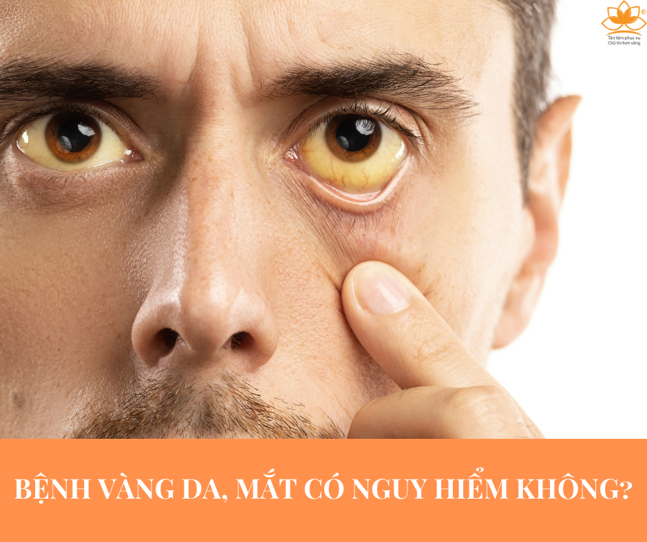 BỆNH VÀNG DA, MẮT Ở NGƯỜI LỚN CÓ NGUY HIỂM KHÔNG?